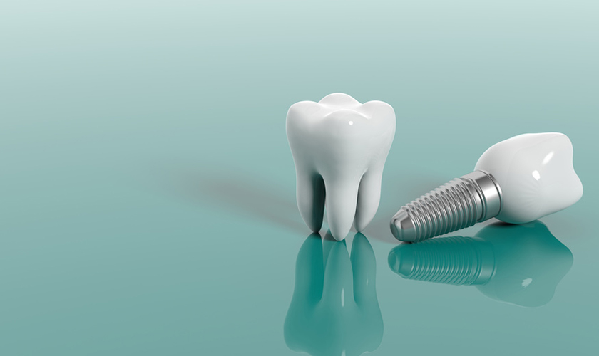 Quy trình cắm Implant cơ bản sẽ diễn ra qua 6 bước