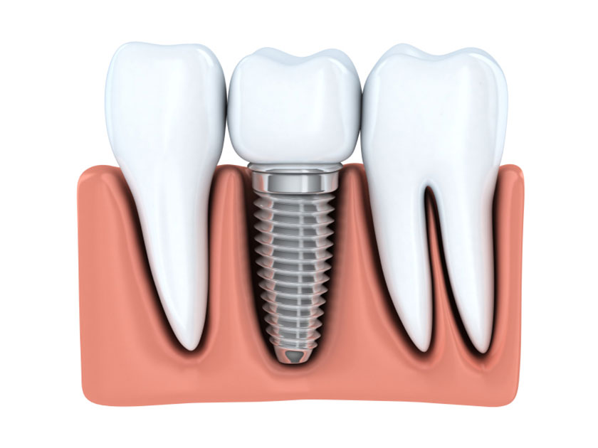 Bảng giá cắm Implant tại nha khoa Nhân Tâm