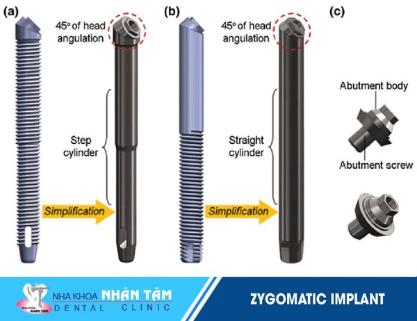 Trụ cấy ghép Implant Zygoma - thành tựu trồng răng trong nha khoa hiện đại