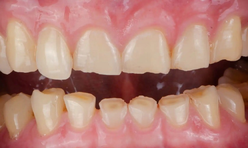 Máng chống nghiến giúp ngăn ngừa mòn men răng hiệu quả