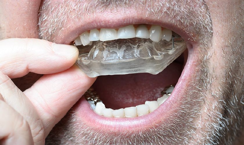 Máng chống nghiến có tác dụng bảo vệ cấu trúc răng