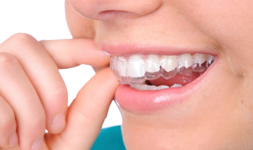 Máng chống nghiến là phương pháp điều trị nghiến răng đơn giản mà hiệu quả