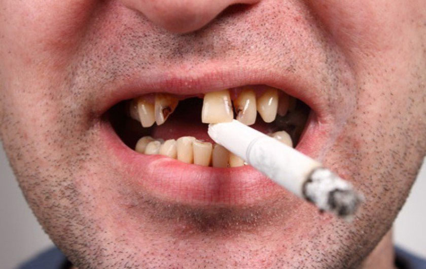 Tật nghiến răng – Tác hại và cách điều trị