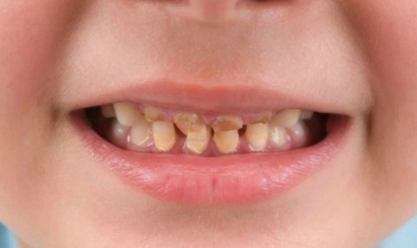 Nghiến răng thường xuyên gây mòn men răng ở trẻ Nghiến răng thường xuyên gây mòn men răng ở trẻ