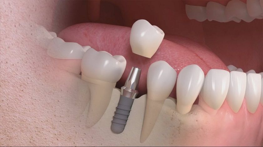 Thực hiện Implant cho người cao tuổi bị mất răng