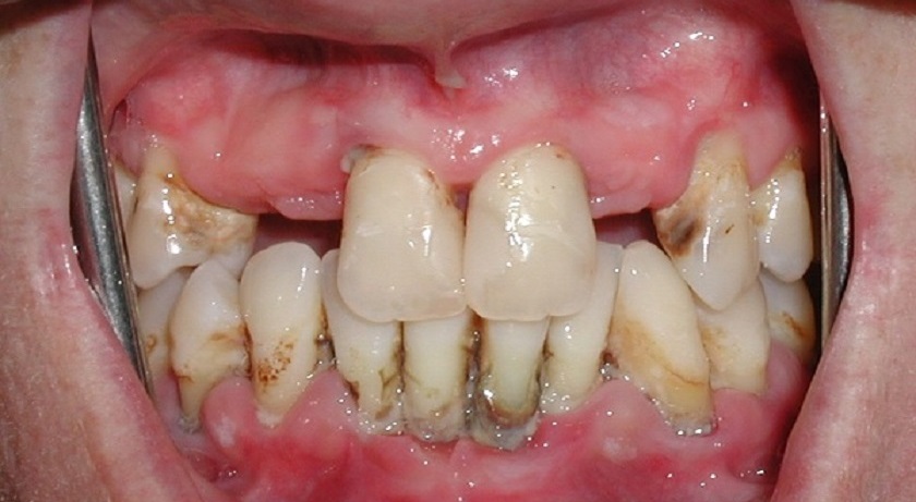 Bệnh nha chu cần được chữa trị kịp thời để tránh làm ảnh hưởng tới sức khỏe