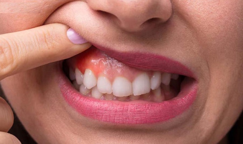 Người mắc bệnh nha chu có trồng răng Implant được không?