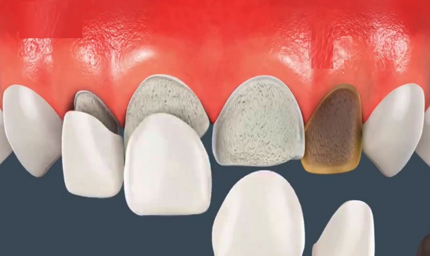 Nguyên nhân và cách xử lý khi răng sứ bị rớt ra