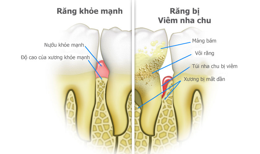 Răng khỏe mạnh và răng bị viêm nha chu