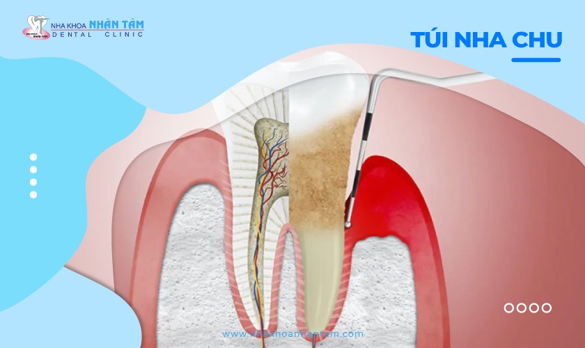 Túi nha chu: Nguyên nhân, triệu chứng và cách điều trị