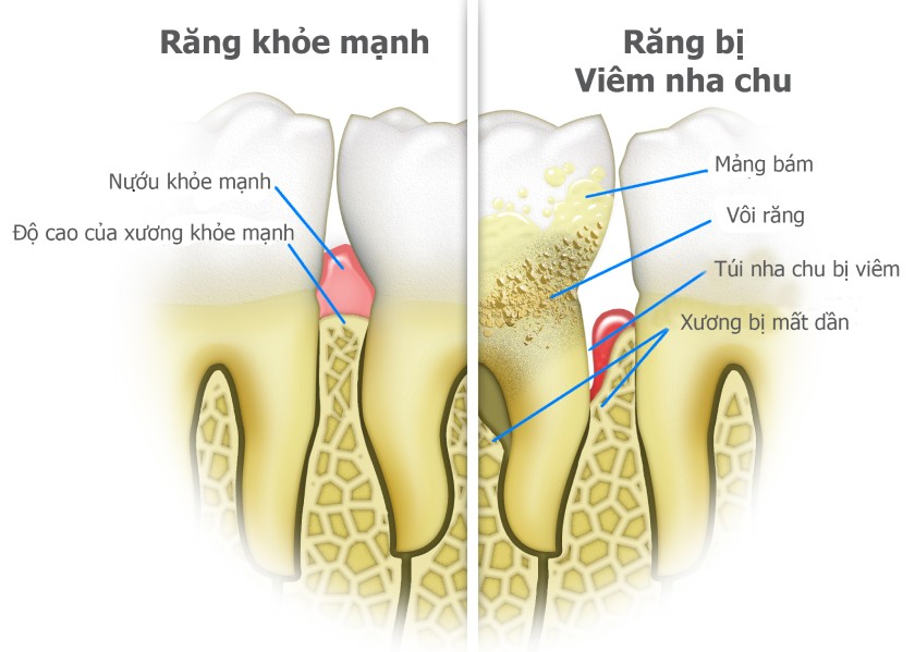 Túi nha chu là một khoảng trống giữa răng và nướu, hình thành do mảng bám lâu ngày không được loại bỏ