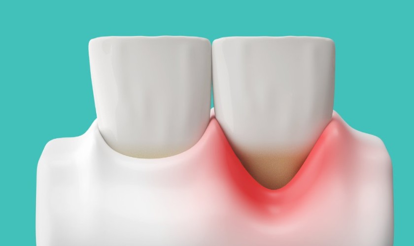 Quá trình hình thành túi nha chu diễn ra qua nhiều giai đoạn khác nhau