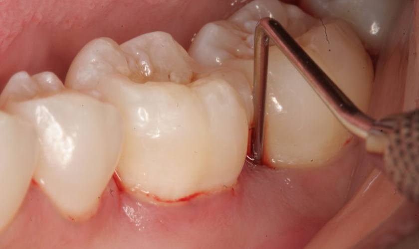 Túi nha chu có thể dẫn đến mất răng