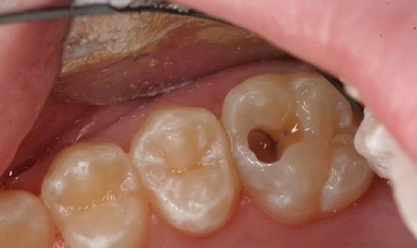 Nhét gì vào răng sâu để giảm đau?