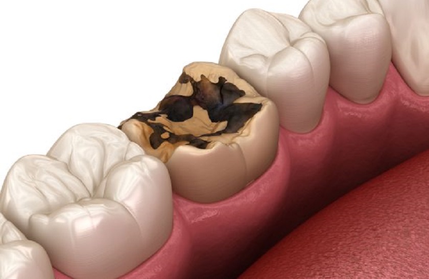 Răng bị hư hại nặng cần nhổ bỏ và phục hình lại Răng bị hư hại nặng cần nhổ bỏ và phục hình lại