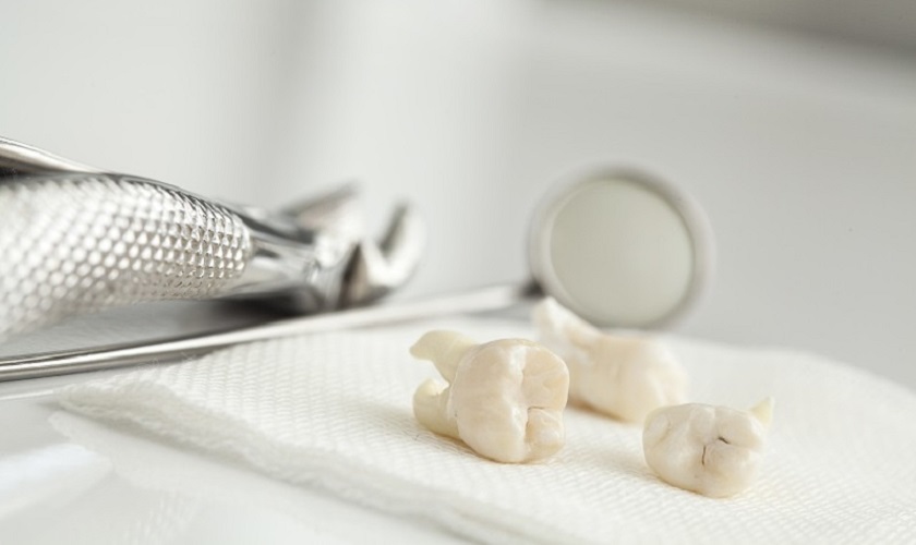 Nhổ 2 răng hàm cùng lúc có ảnh hưởng gì tới sức khỏe?