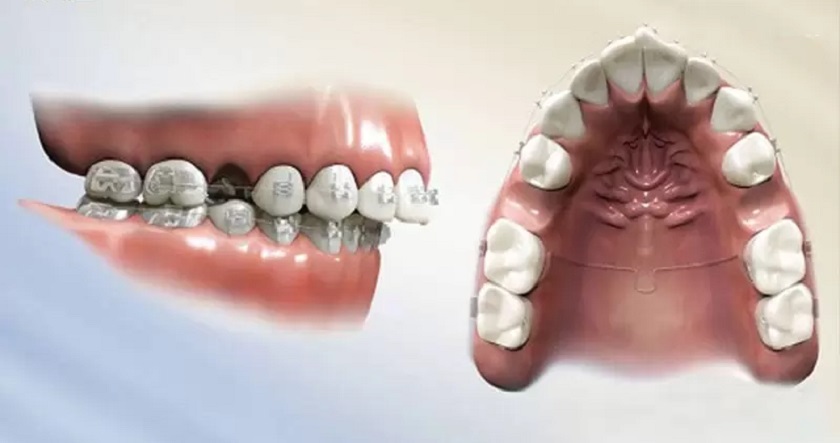 Nhổ răng 4 chỉnh nha thường được chỉ định khi niềng răng hô