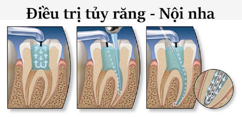 Điều trị tủy răng nếu có dấu hiệu viêm nhiễm hoặc hoại tử