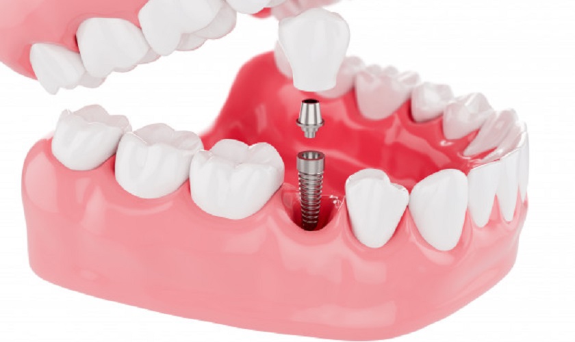Cấy ghép Implant – Biện pháp phục hình răng tối ưu nhất hiện nay