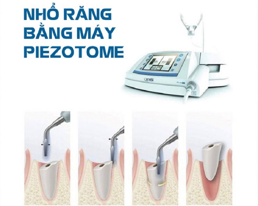 Công nghệ nhổ răng không đau bằng máy siêu âm Piezotome