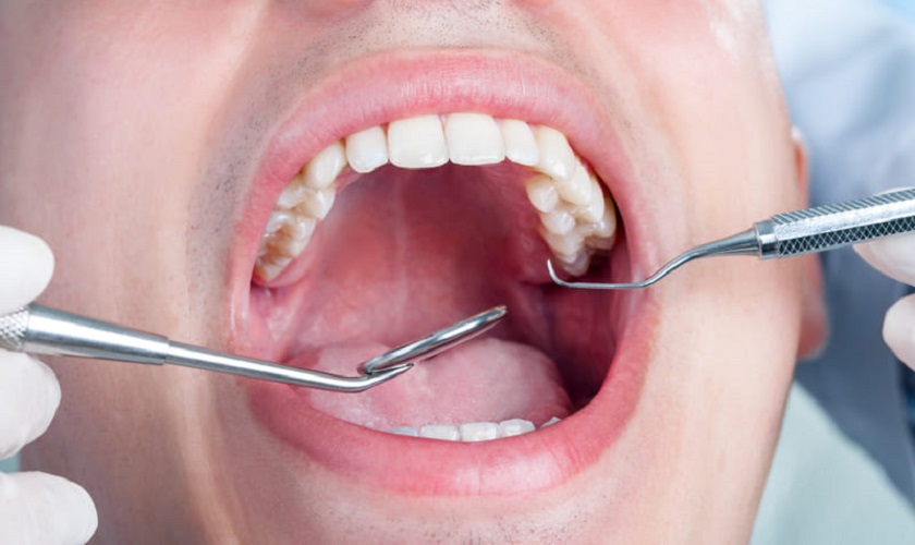 Nhổ răng hàm trên trong cùng bị sâu – nên hay không?
