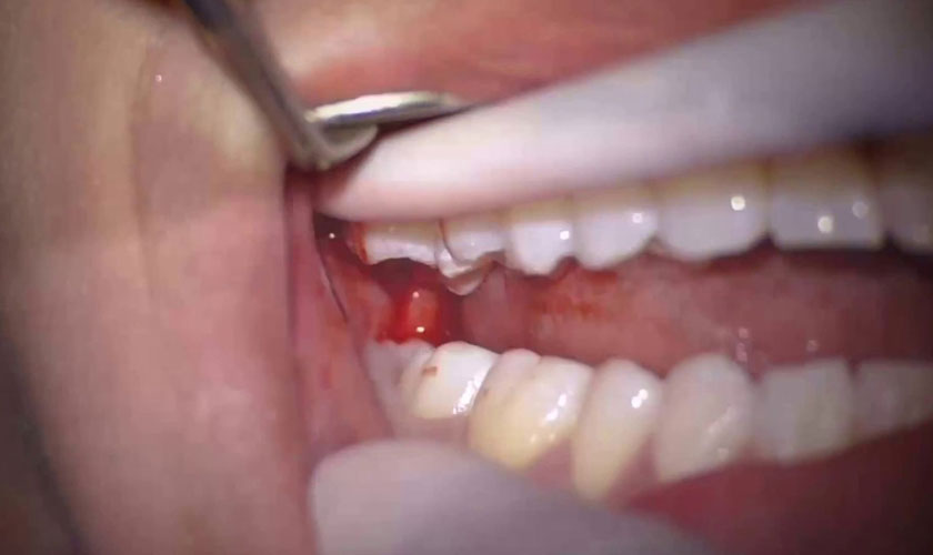 Dấu hiệu mọc răng khôn hàm trên