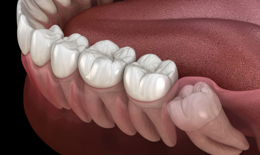 Răng khôn mọc lệch - Nhổ răng khôn giá bao nhiêu?