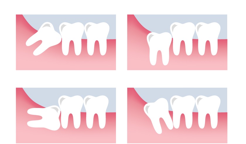 Các trường hợp mọc lệch của răng khôn