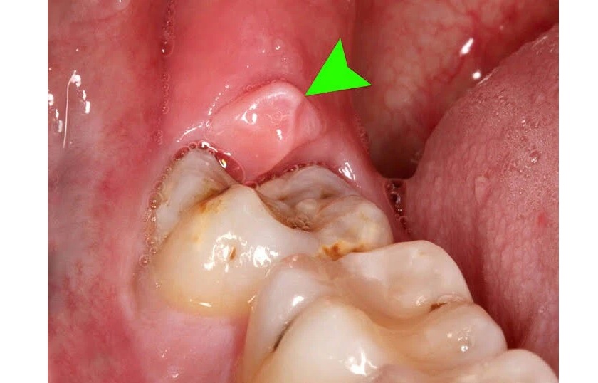 Viêm nướu răng do mọc răng khôn gây ra Viêm nướu răng do mọc răng khôn gây ra