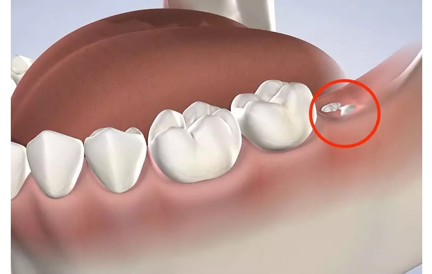 Răng khôn tách nướu mọc lên