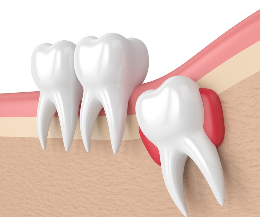 Chăm sóc sau nhổ răng khôn