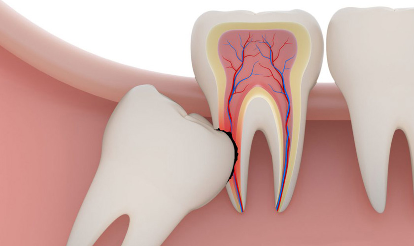 Răng khôn mọc lệch sẽ có xu hướng đâm sang răng số 7 bên cạnh