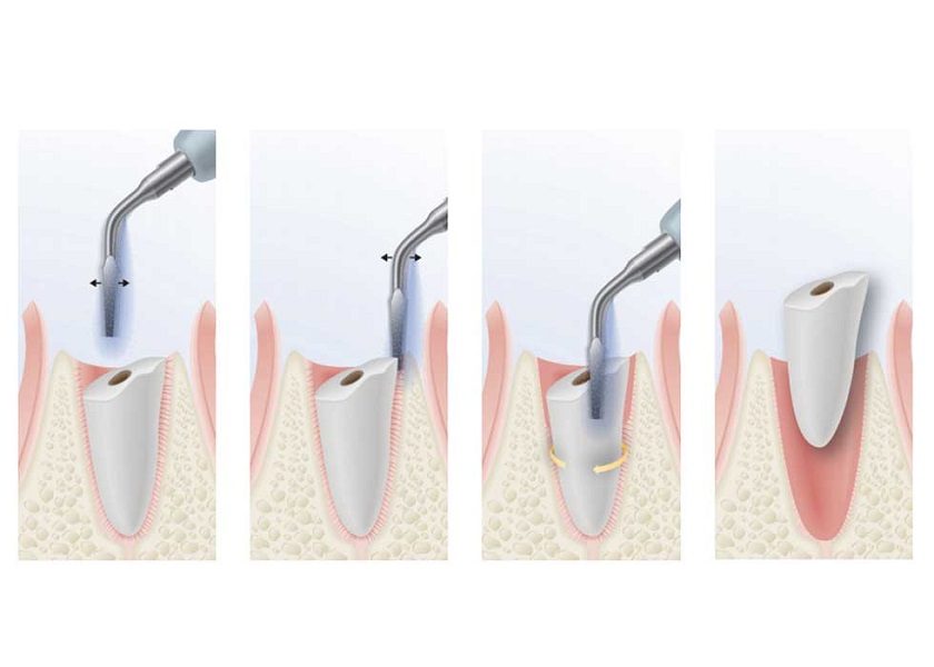 Sóng siêu âm Piezotome không gây nên tổn thương đến các mô mềm xung quanh răng
