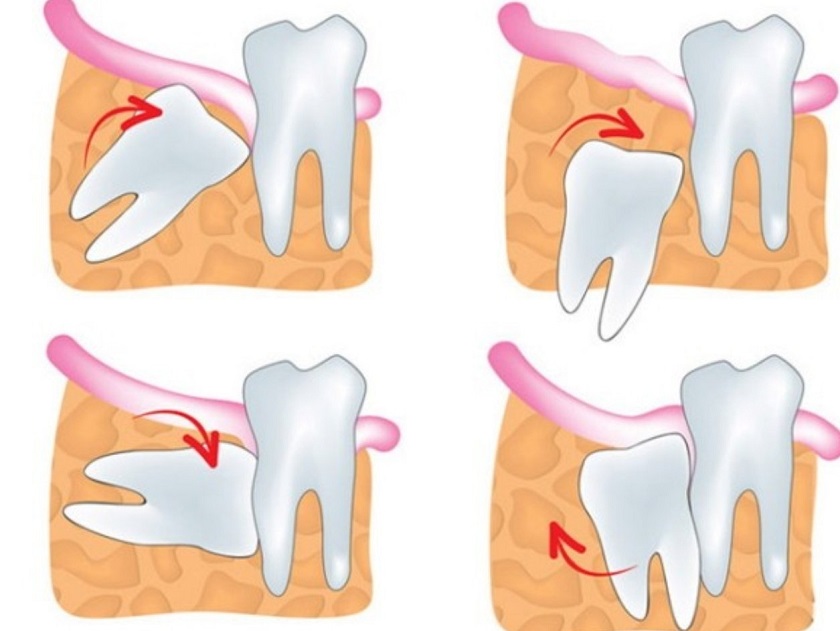 Răng khôn khi mọc lệch, mọc ngầm nếu không nhổ bỏ kịp thời sẽ gây ra những hậu quả nghiêm trọng