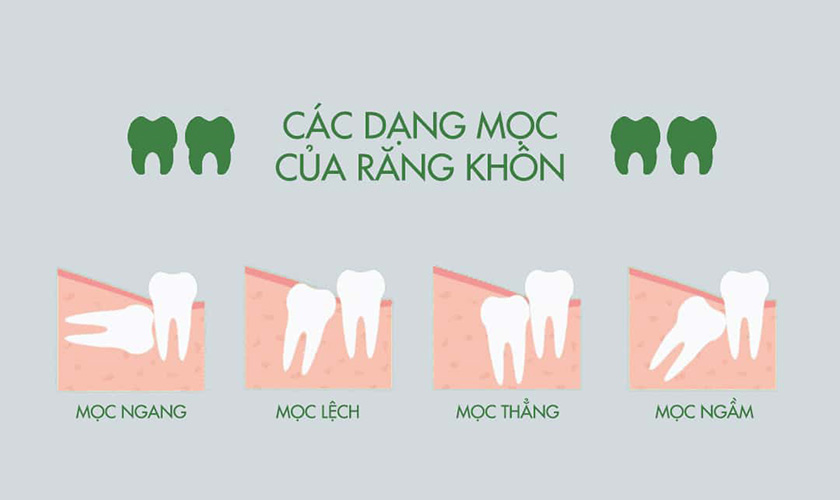 Răng khôn (Răng số 8) và các rắc rối khó lường