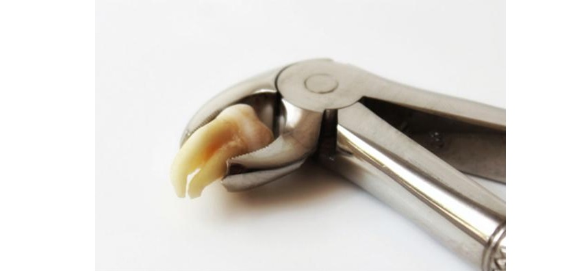 Răng khôn có nên nhổ bỏ hay không?