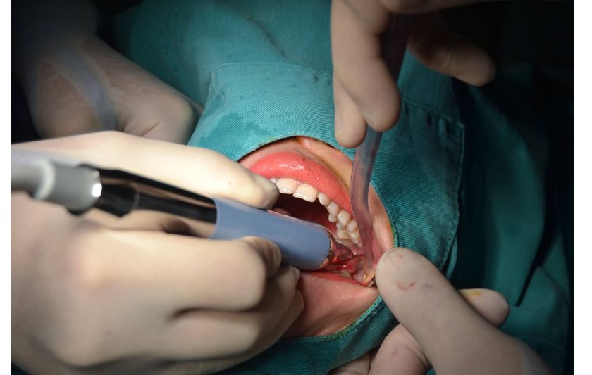 Những trường hợp được chỉ định nhổ răng khôn là gì?