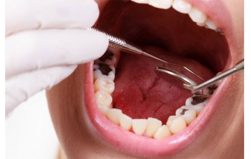 Răng khôn bị sâu có thể gây suy giảm sức khoẻ răng miệng