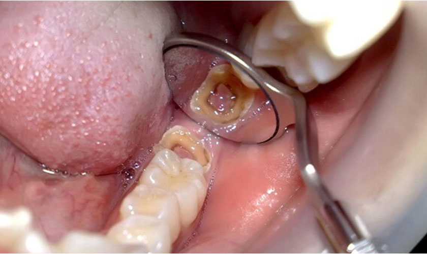 Răng khôn bị sâu - Nên nhổ hay trám răng?
