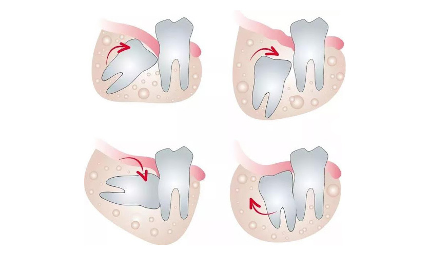 Răng khôn rất dễ bị sâu do khó vệ sinh