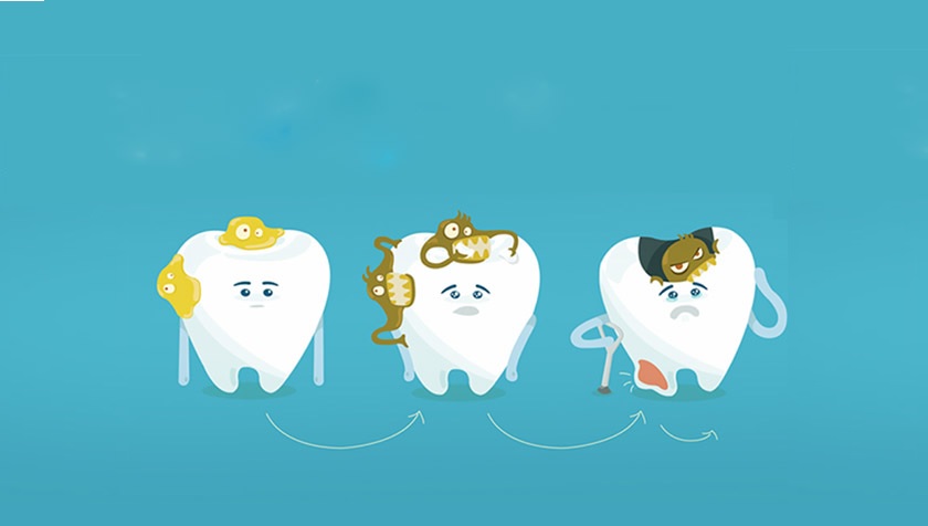 Vì có mặt nhai lớn, nhiều rãnh, kẽ và vị trí khuất nên răng khôn dễ bị sâu