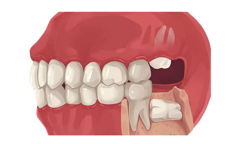 Răng khôn khi mọc lệch, mọc ngầm, về lâu dài sẽ khiến những răng khác di chuyển lộn xộn, xô lệch