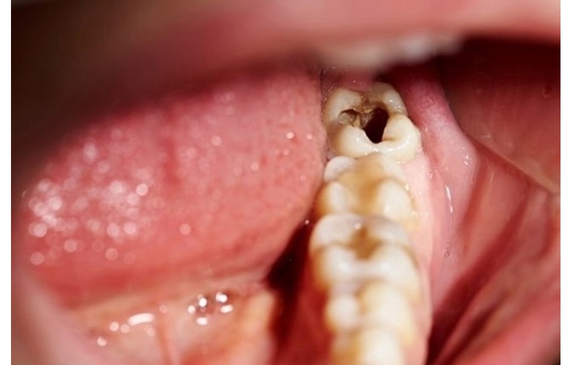 Răng khôn bị sâu