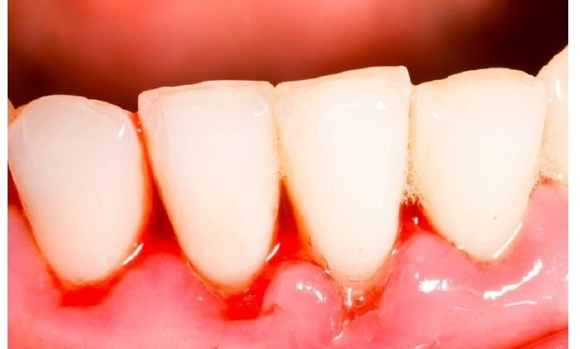 Nướu bị sưng đỏ khi mọc răng khôn