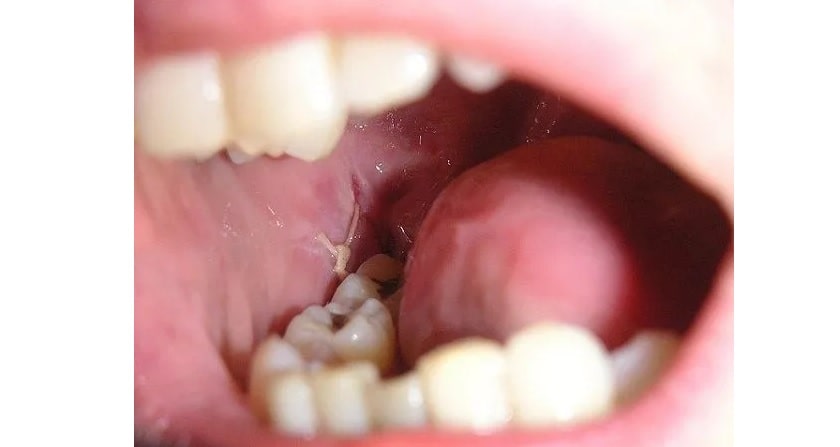 Tiểu phẫu nhổ răng khôn