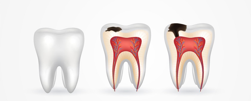 Thức ăn tích tụ lâu ngày tại răng khôn sẽ gây ra sâu răng