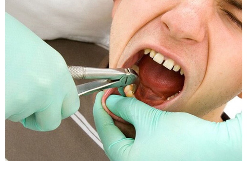 Có cần cắt chỉ sau khi nhổ răng khôn không? Có cần cắt chỉ sau khi nhổ răng khôn không?