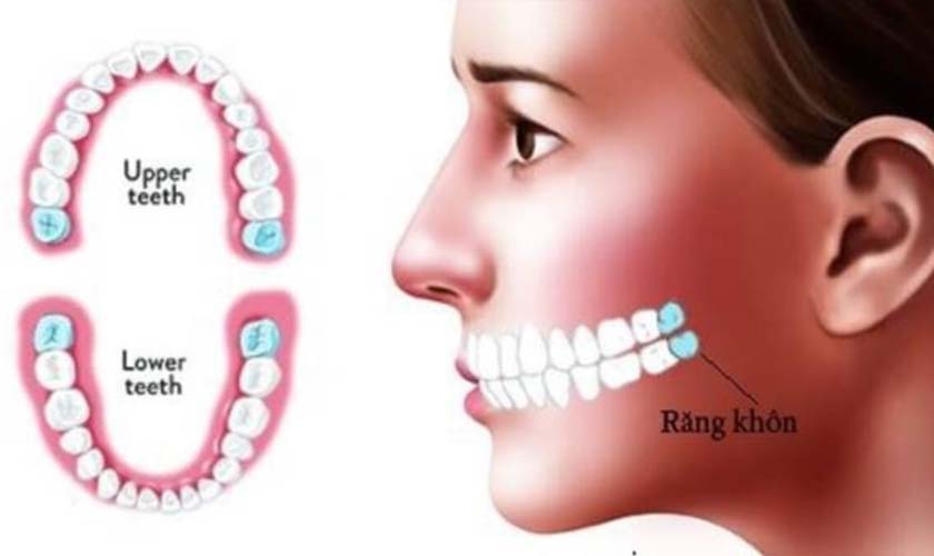 8 triệu chứng mọc răng khôn bạn cần chú ý