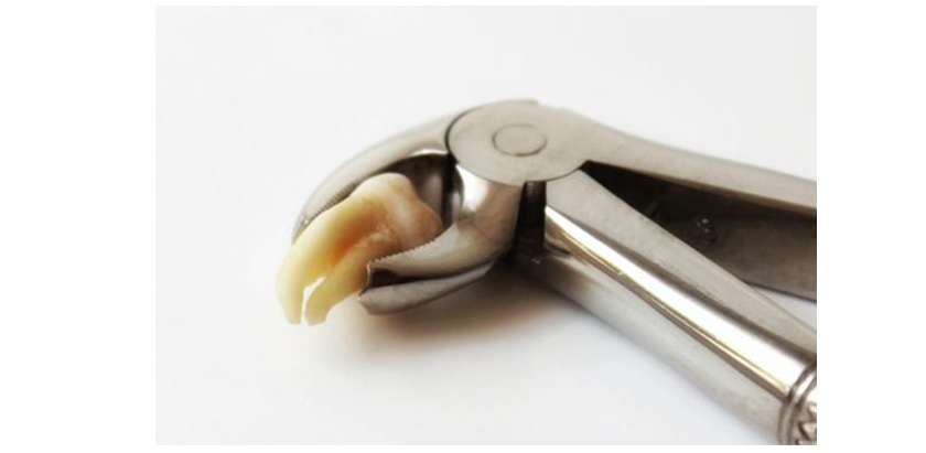 Nhổ bỏ răng khôn bị mọc ngầm