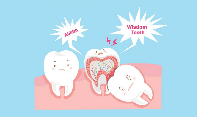 Răng khôn mọc khi nào? Mọc răng khôn có bị sốt không?
